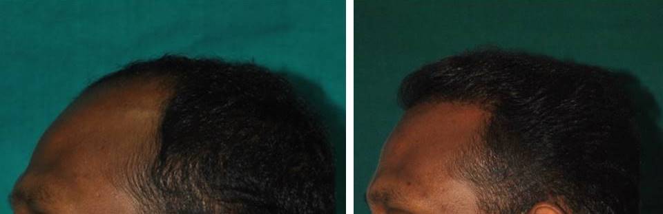 Front zone hair transplant in Kerala